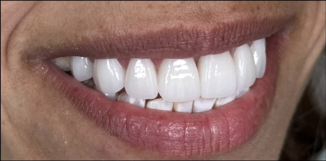 After dental treatment