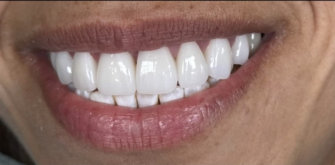 After dental treatment