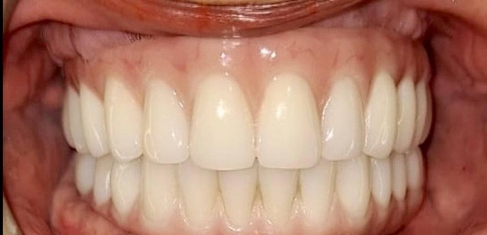 After dental treatment