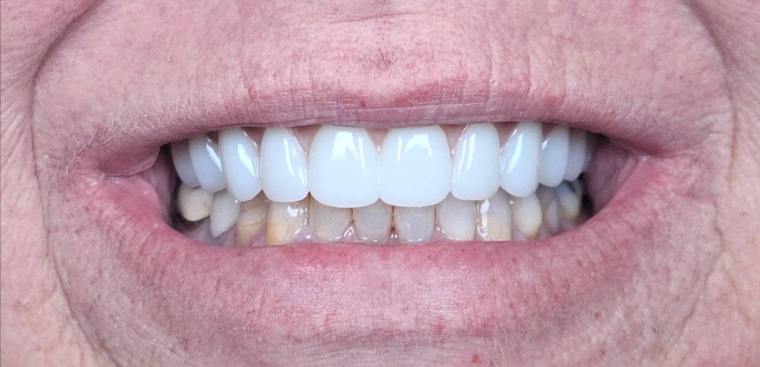 After dental treatment