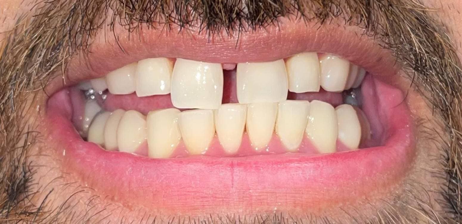 Before dental treatment